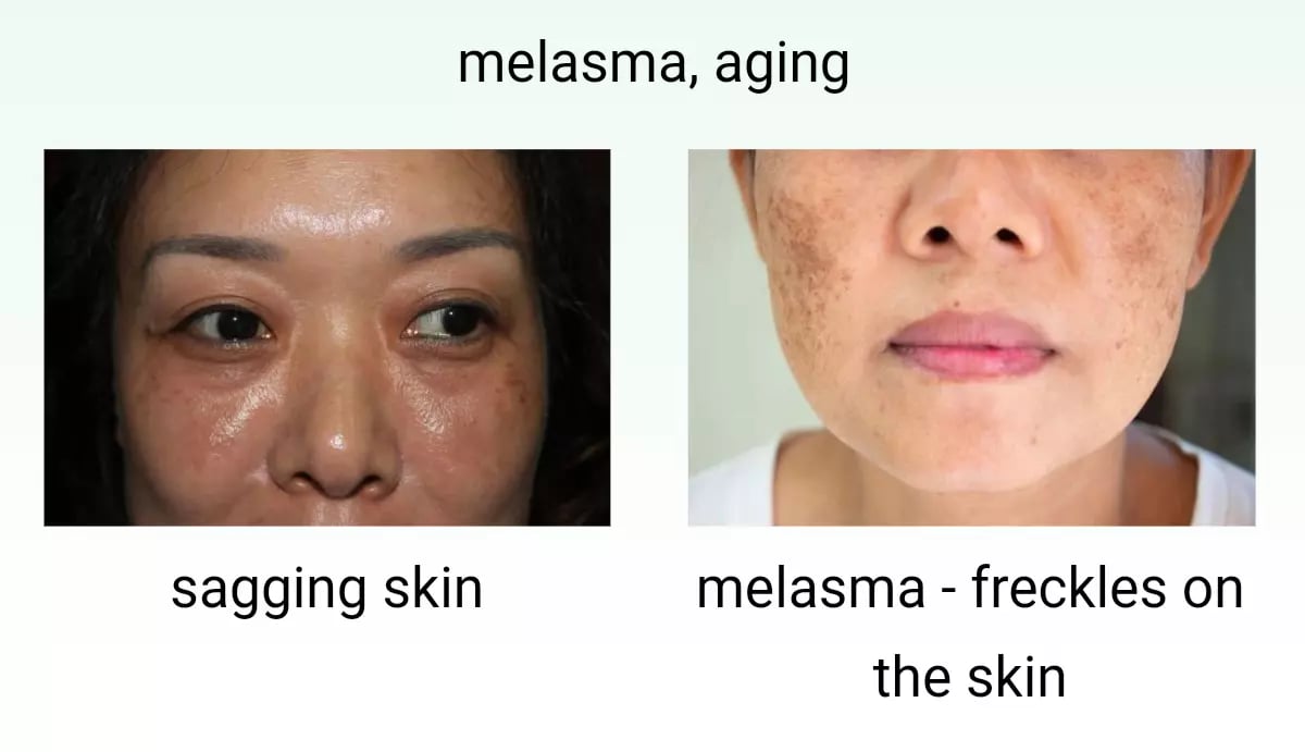 🤩Japanese Melasma Cream [Buy 1 Get 1 Free]🤩